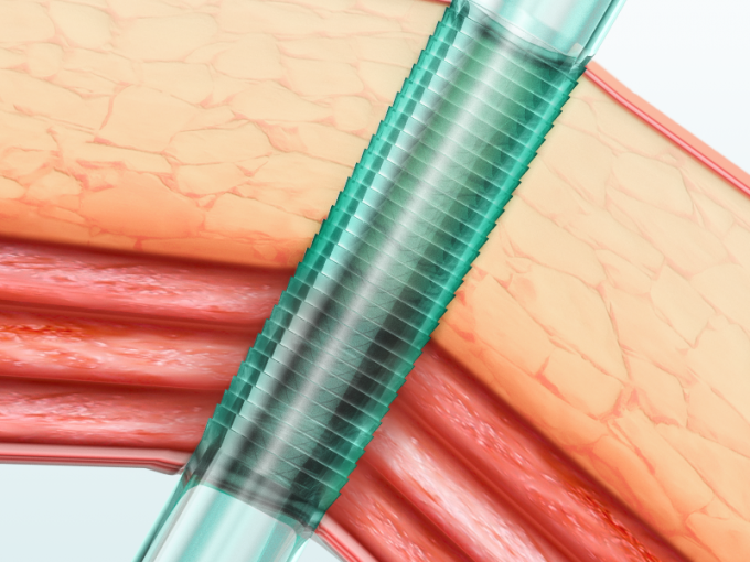 najnowsze wiadomości o firmie Cechy i zalety jednorazowego trokara laparoskopowego Endopass | SurgSci  0