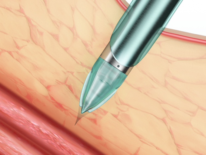 najnowsze wiadomości o firmie Cechy i zalety jednorazowego trokara laparoskopowego Endopass | SurgSci  1