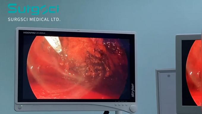 najnowsza sprawa firmy na temat SurgSci ultradźwiękowy skalpel w użyciu | Naprawa przepukliny | Surgsci  0