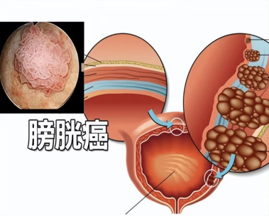 najnowsze wiadomości o firmie Diagnoza kliniczna i fizjologiczna opieka nad rakiem pęcherza moczowego. 0